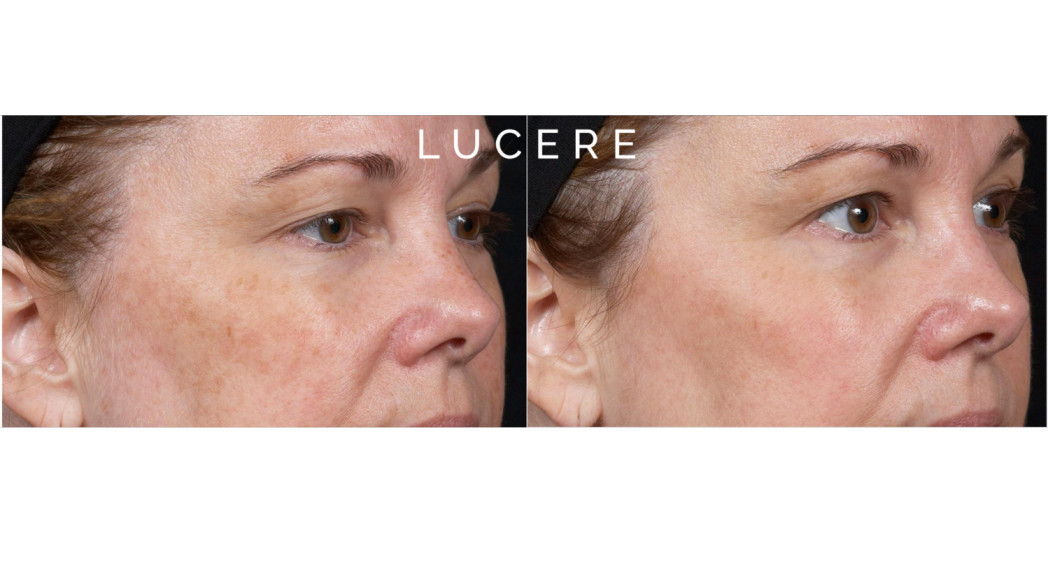Clear + Brilliant before and after