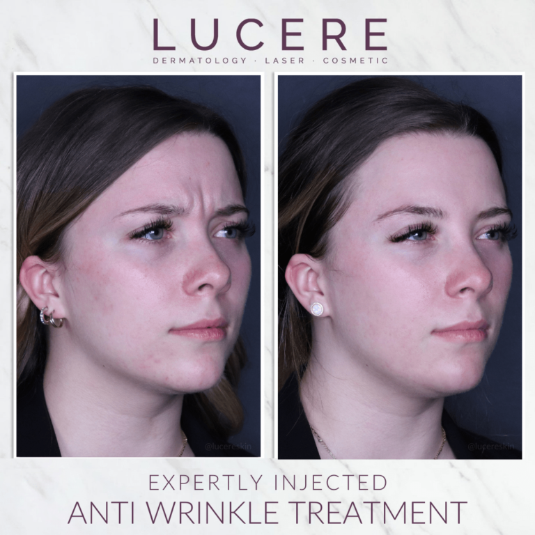 Botox anti wrinkle treatment before and after