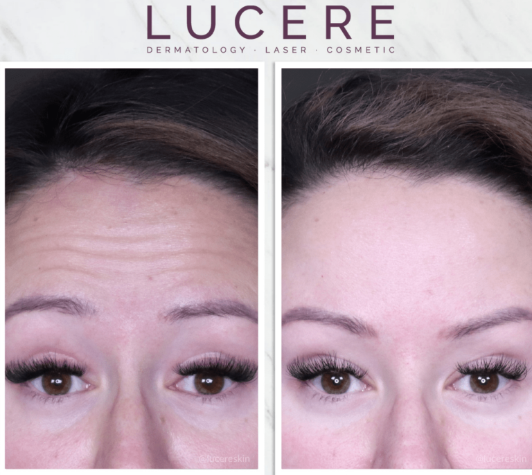 Botox injections for wrinkle before and after