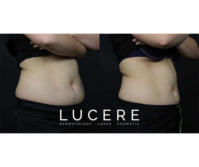 sculpsure before and after