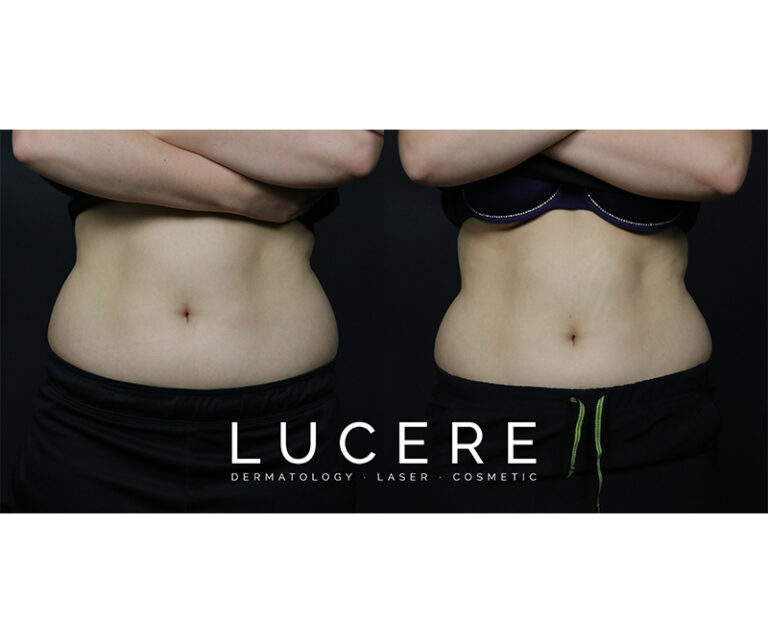sculpsure before and after front