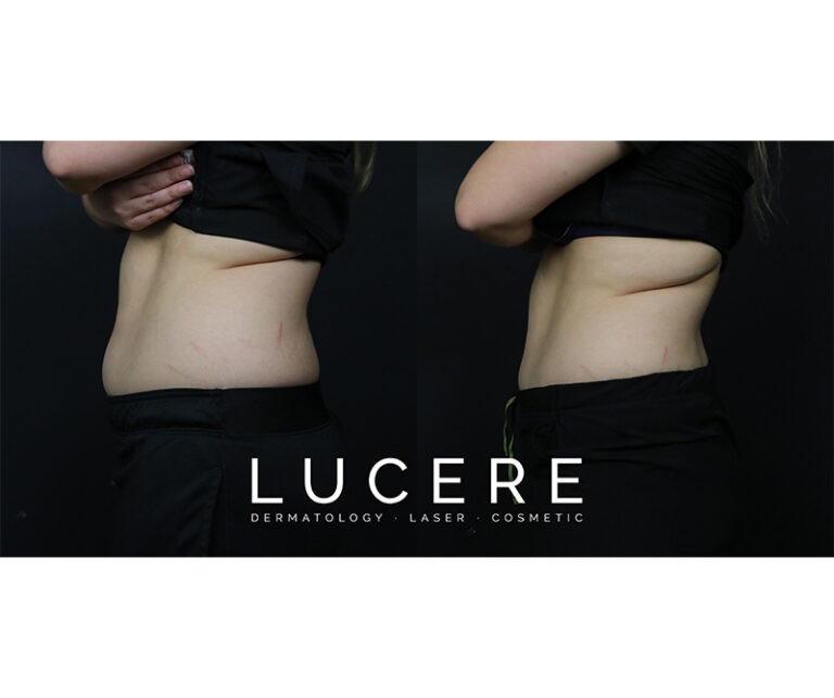 sculpsure before and after results