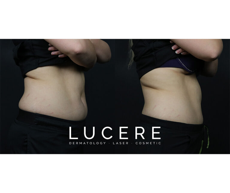 sculpsure before and after front side