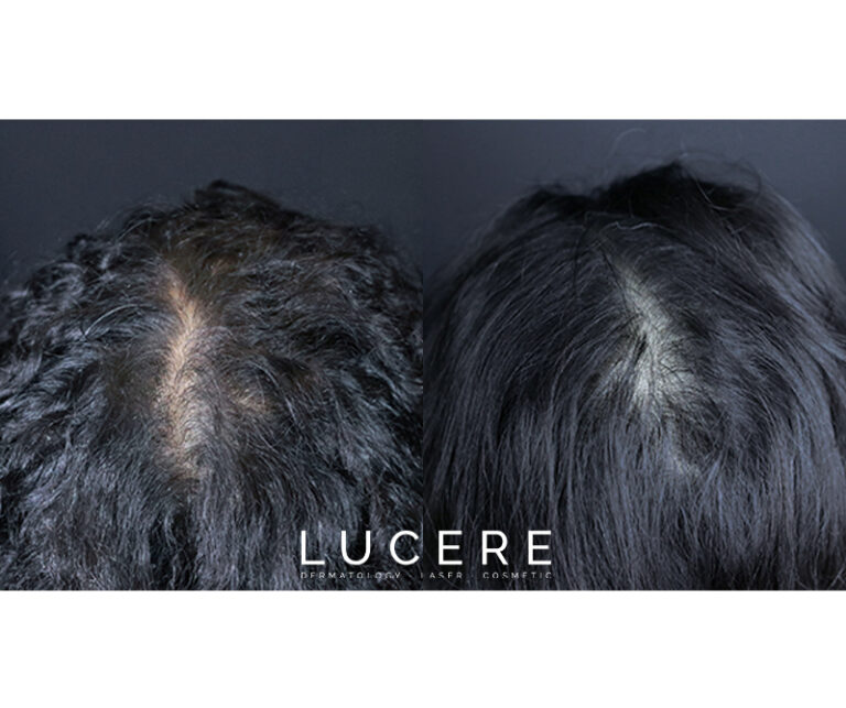 PRP Hair loss before and after