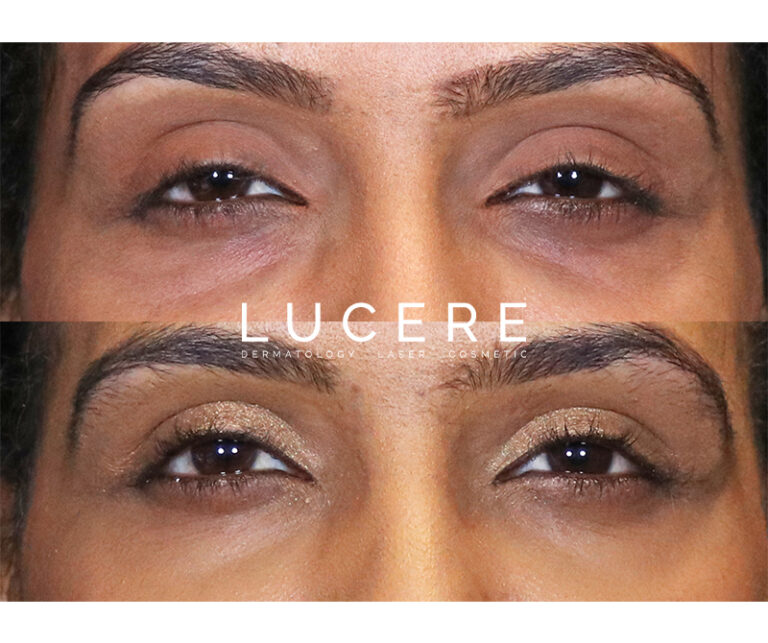 Undereye Filler Treatment before and after