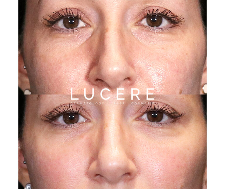 under eye fillers before and after results