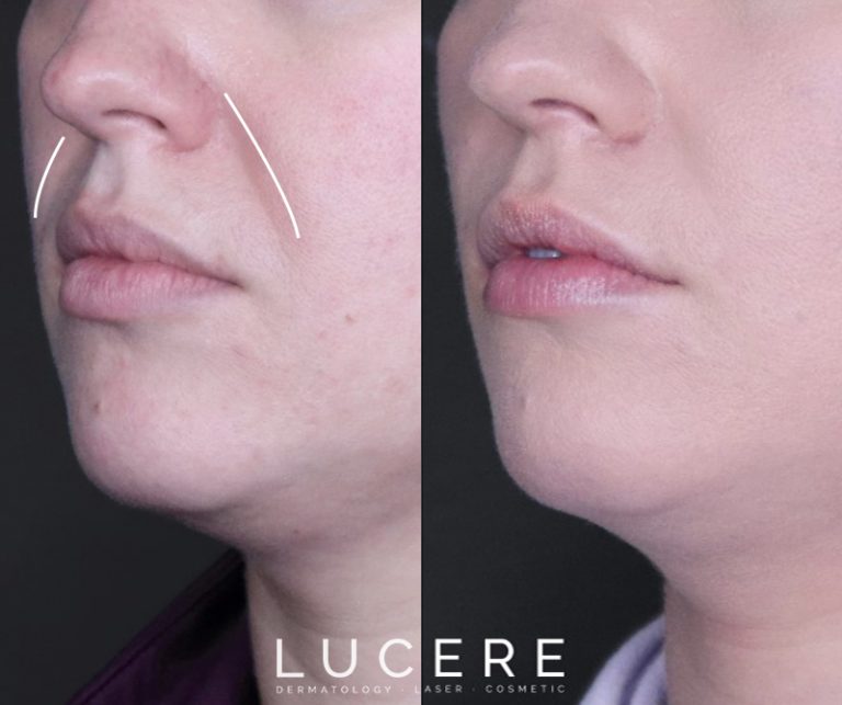 Nasolabial Front Close Up before and after results