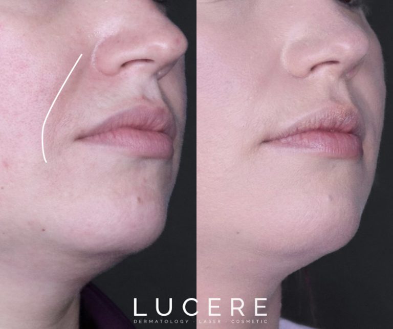 Nasolabial Front Close Up before and after results