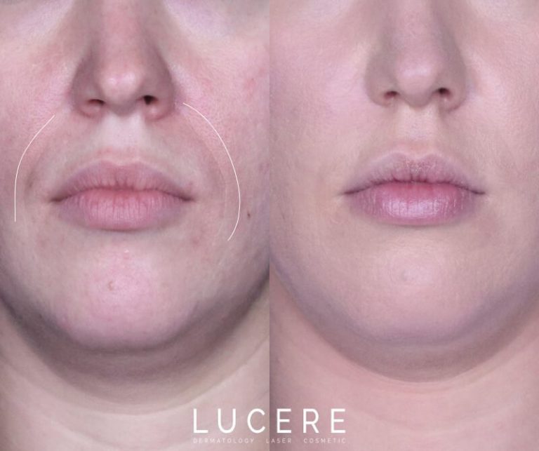 Nasolabial Front Close Up before and after results