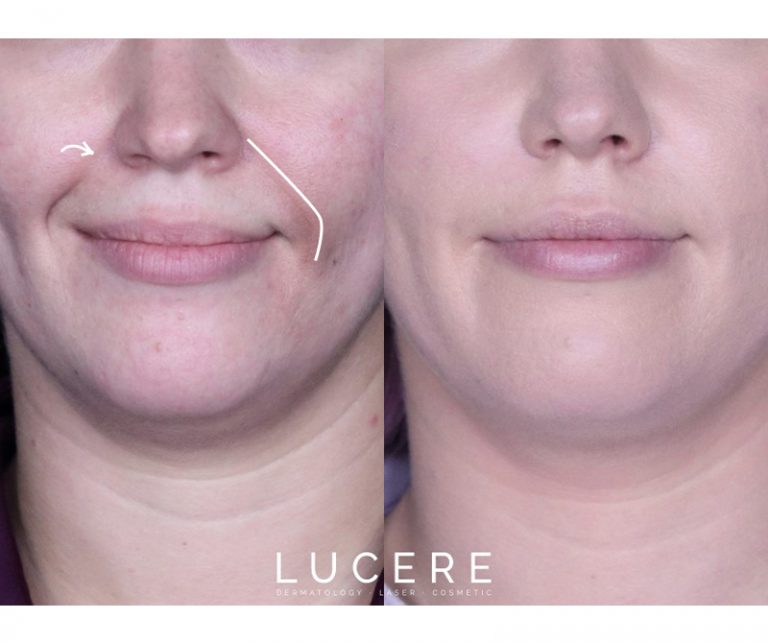 Nasolabial Front Close Up before and after results