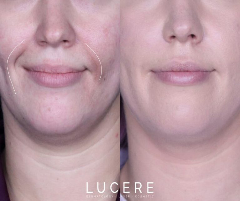 Nasolabial Front Close Up before and after results