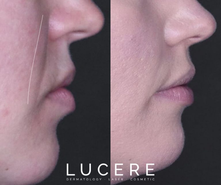 Nasolabial Front Close Up before and after results