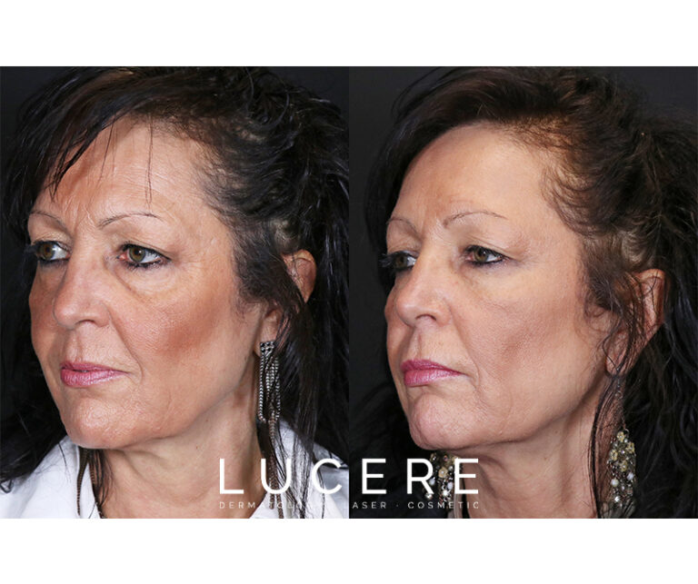 Undereye Filler Treatment left side before and after