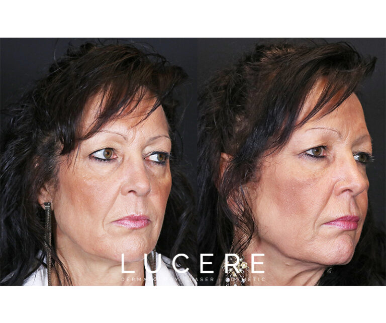 Undereye Filler Treatment right side before and after