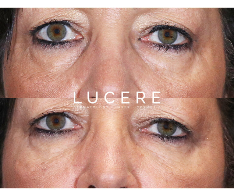 Undereye Filler Treatment before and after