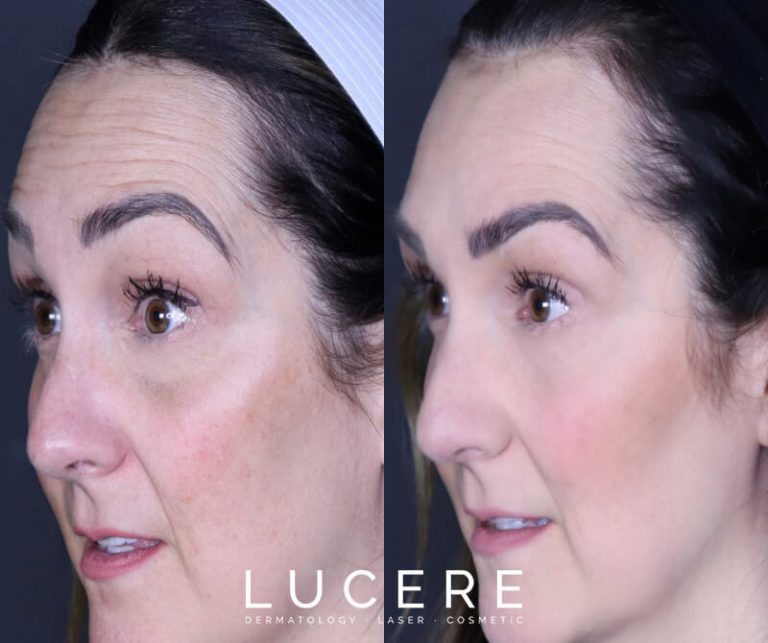 Botox for Forehead & Frown Lines right side before and after