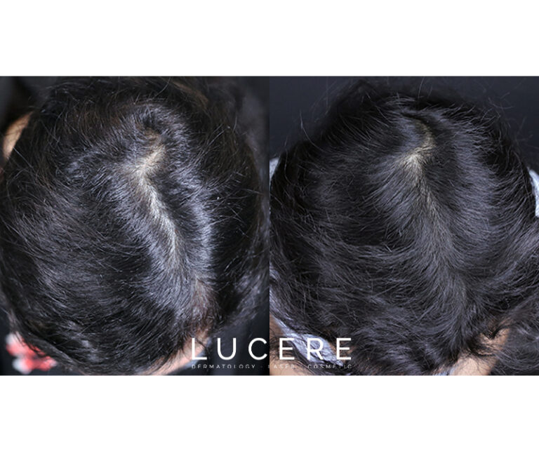 PRP Hair loss before and after