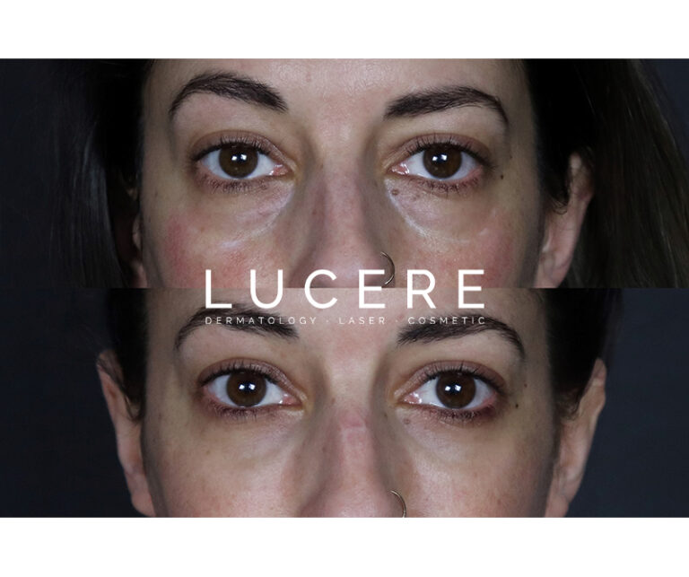 Undereye Filler Treatment front side before and after