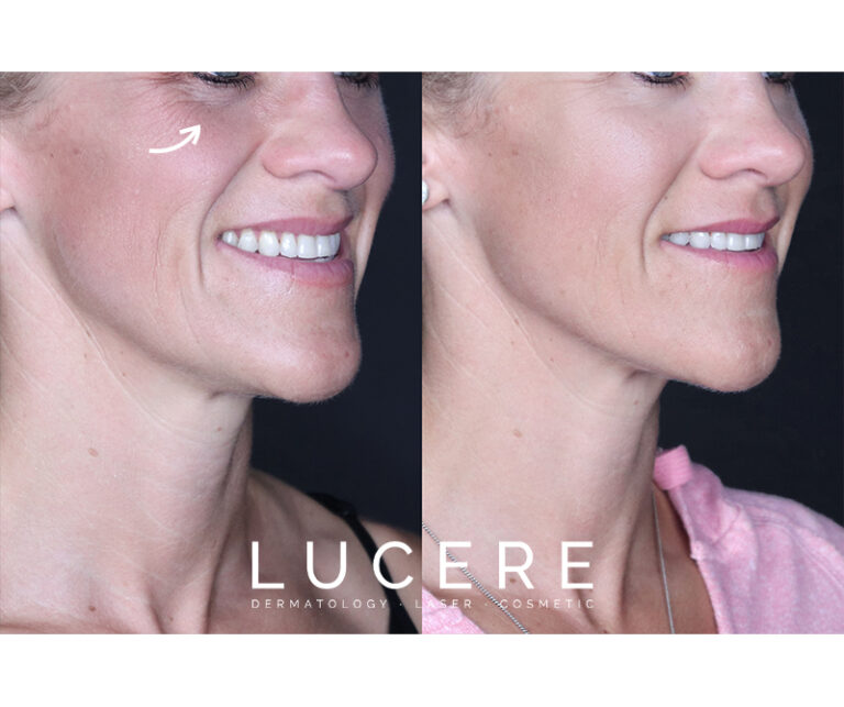 Undereye Filler Treatment side before and after