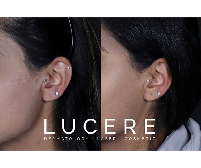 Earlobe Correction Before and After