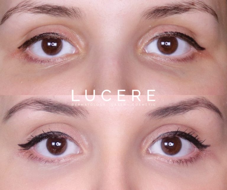 PRP under eye treatment before and after