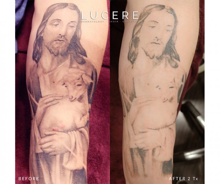 tattoo removal before and after
