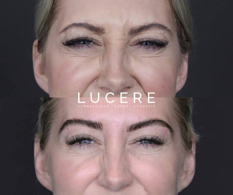 crow's feet treatment front side before and after