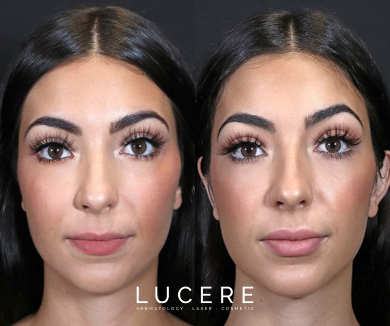 Full face lip filler before and after