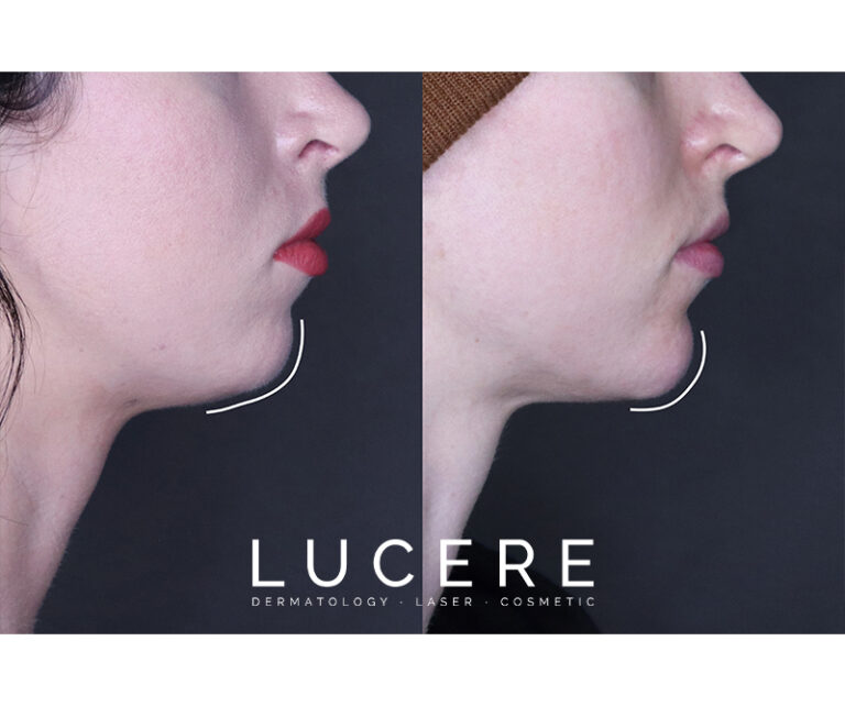 chin fillers before and after results