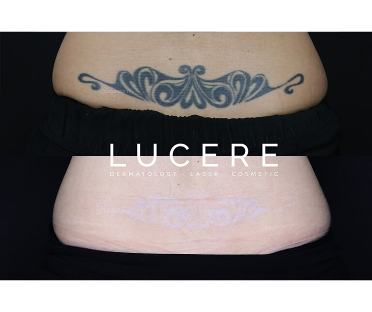 Tattoo Removal in Back Before And After