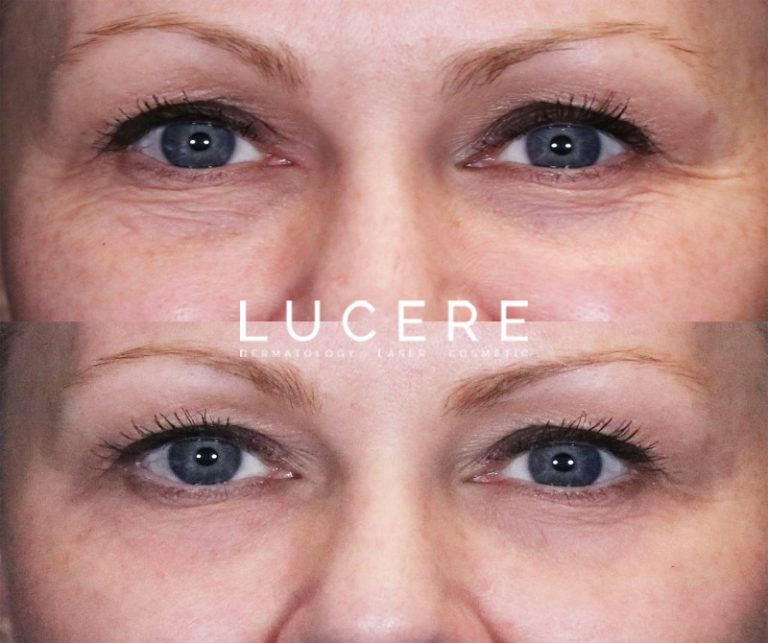 PRP under eye treatment before and after