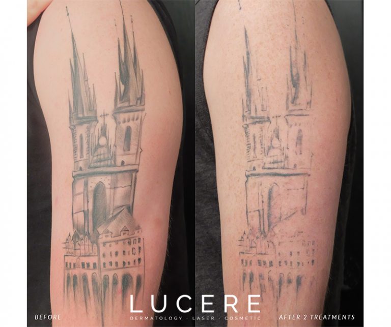 Arm Tattoo removal before and after