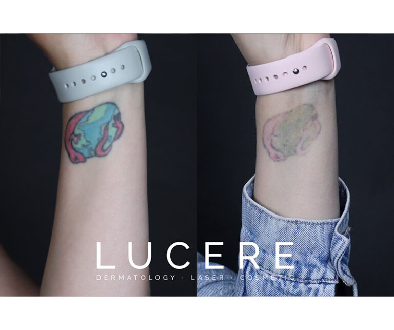 After Tattoo Removal Before and After