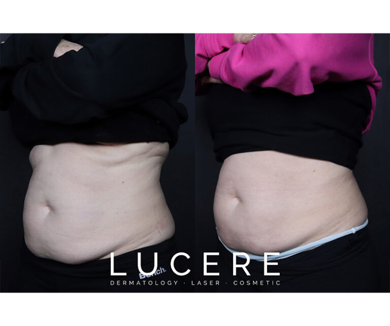 sculpsure before and after front side