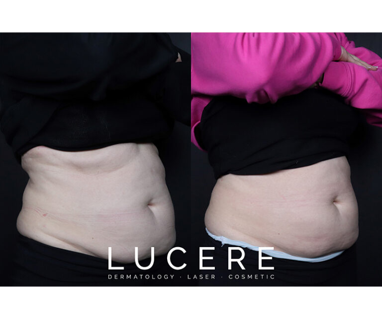 sculpsure before and after front side
