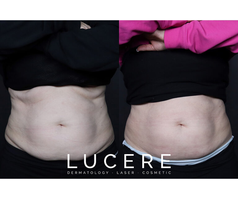 sculpsure before and after front side