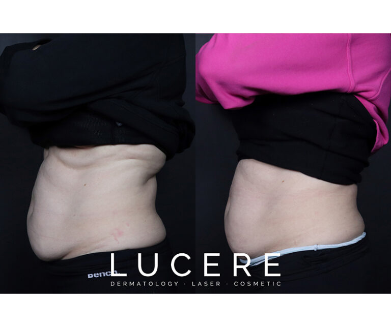 sculpsure before and after left side