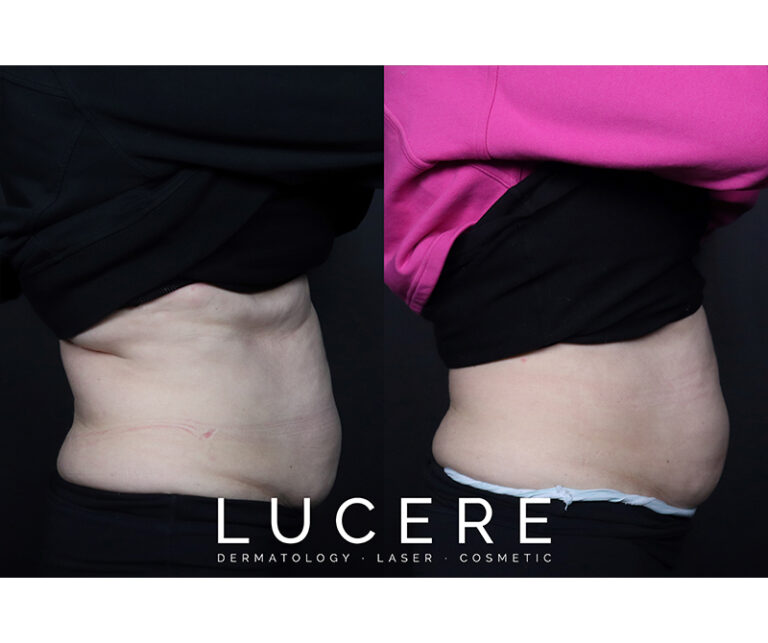sculpsure before and after