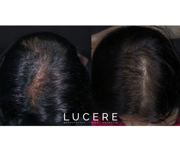 PRP Hair loss before and after