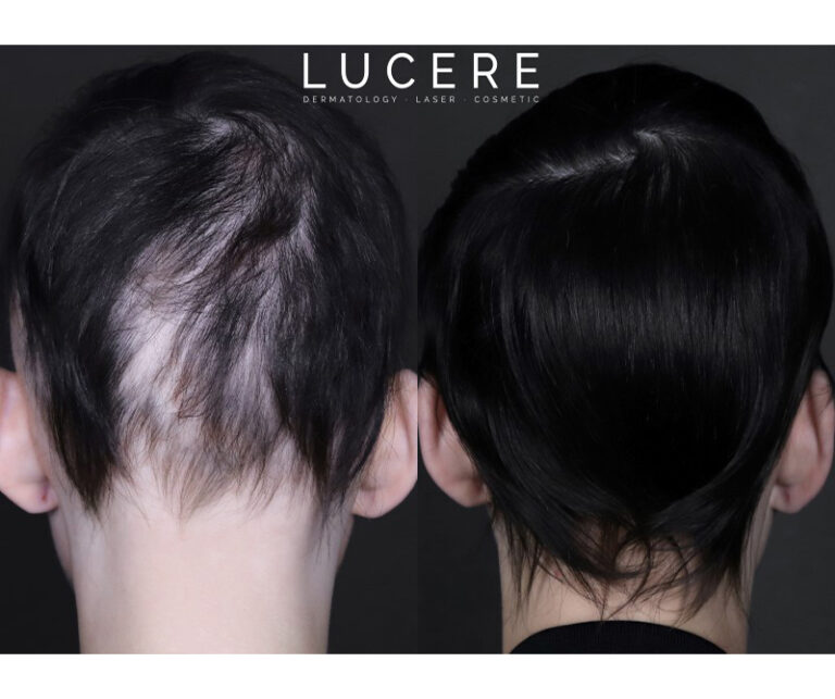 PRP Hair loss before and after