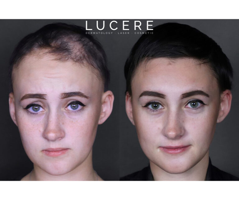 PRP Hair loss before and after