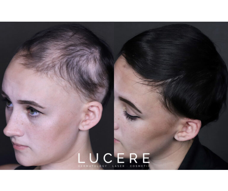 PRP Hair loss before and after