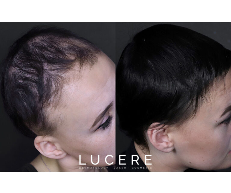 PRP Hair loss before and after