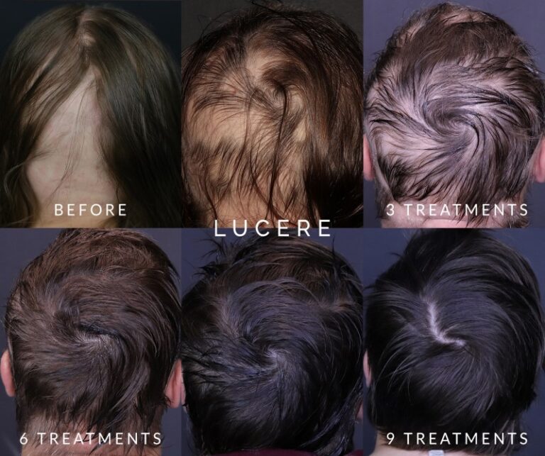 PRP Hair loss before and after