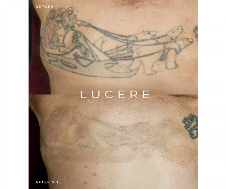 Pico Tattoo Removal - Back results before and after