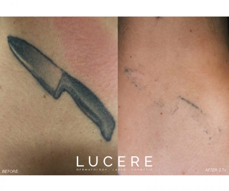 Pico Tattoo Removal Neck before and after