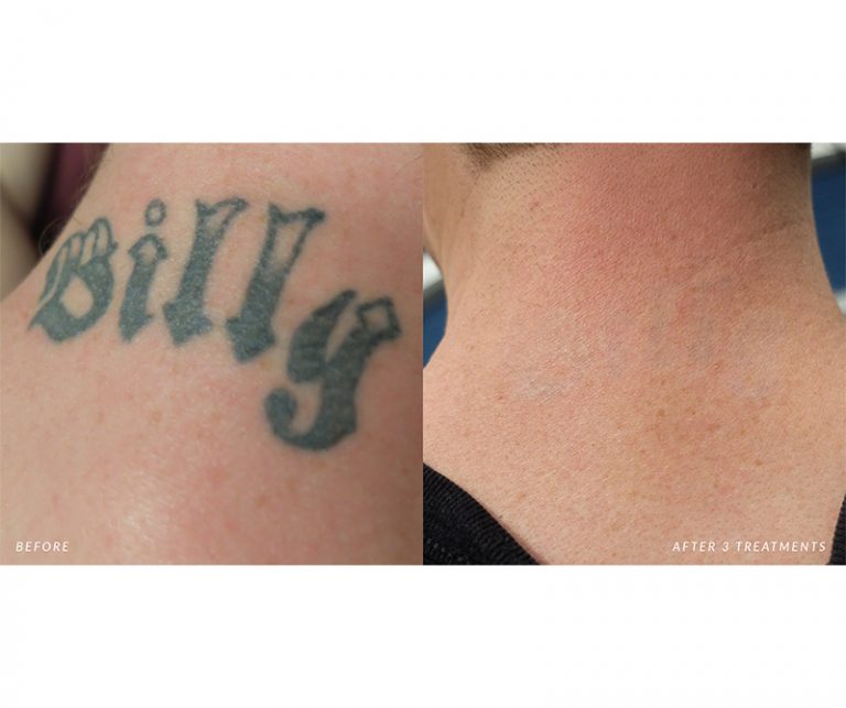 Pico Tattoo Removal -Goosney, B - B&A - Neck