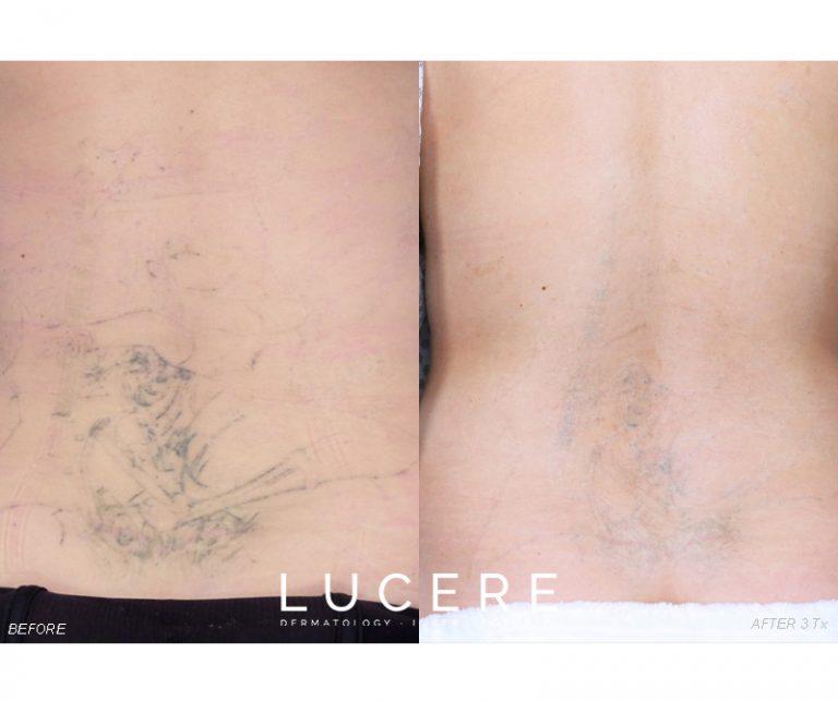 Pico Tattoo Removal results