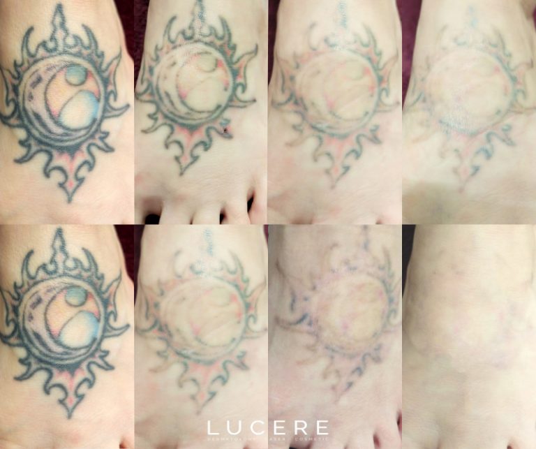 Pico Tattoo Removal before and after