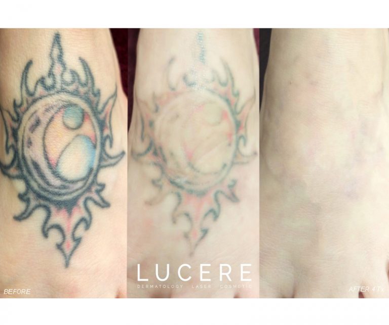 Pico Tattoo Removal before and after